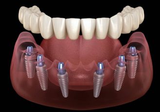 all on 6 dental implants turkey