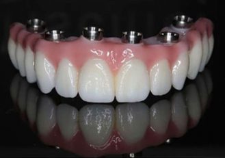 all on 6 dental implants turkey price